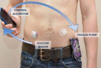 Nhs artificial pancreas diabetes patients