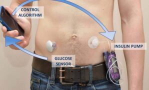 Nhs artificial pancreas diabetes patients