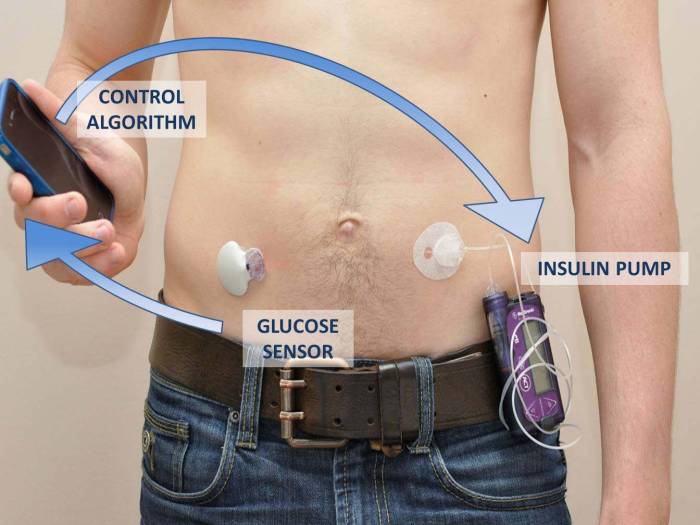 Nhs artificial pancreas diabetes patients