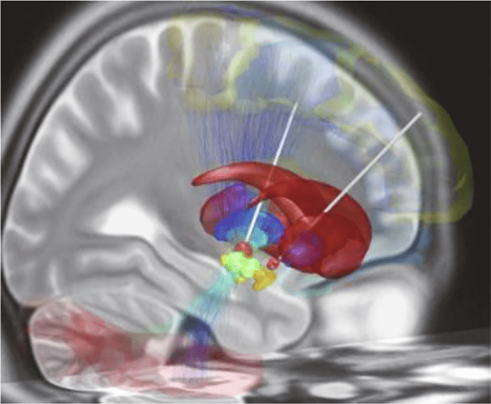 Dutch startup tests hearing via brain computer interface