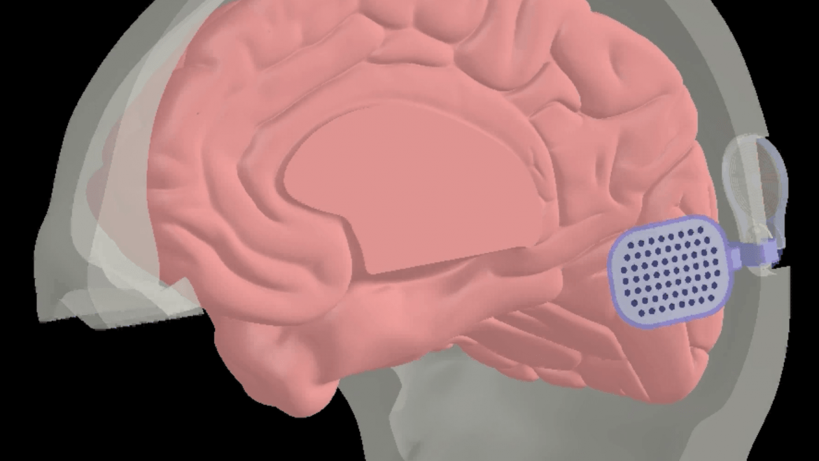 Neuron sized brain implant help blind people see